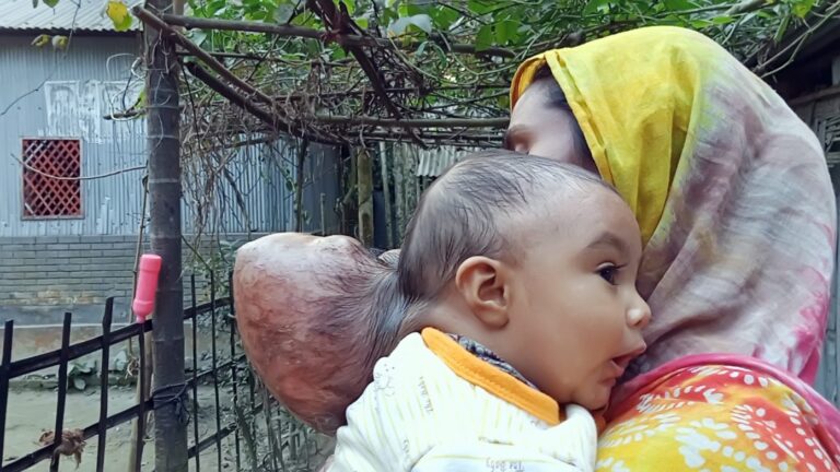 শেরপুরে সাত মাস বয়সের শিশুর মাথার পেছনে দুই কেজি টিউমার, টাকার অভাবে করতে পারছেনা চিকিৎসা