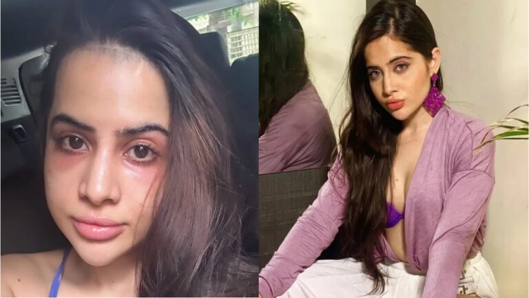 চোখ ফুলে গেছে উরফির চোখ ফুলে গেছে উরফির