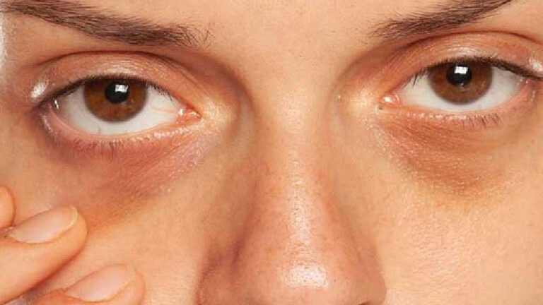 চোখের তলার কালচে দাগ বাড়ছে যে কারণে
